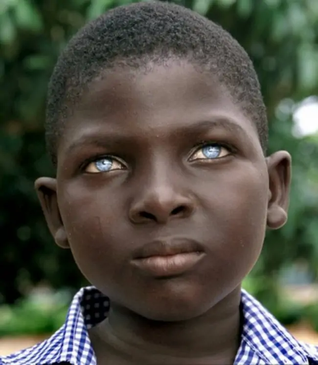 Ocular albinism eyes