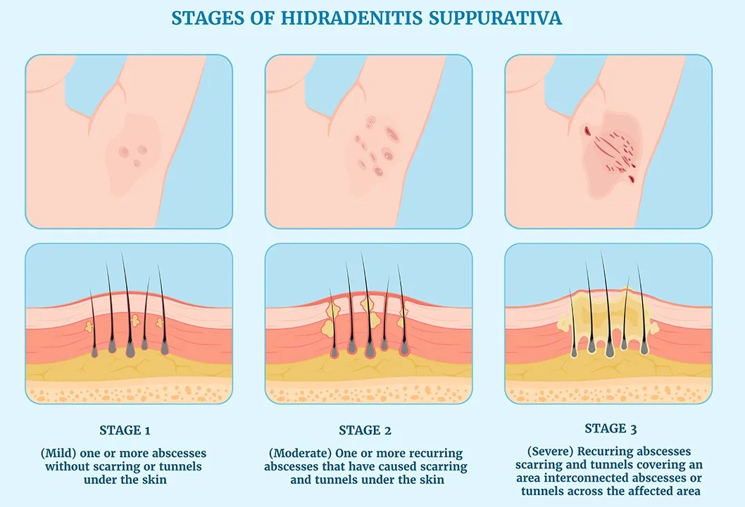 Hidradenitis drawing