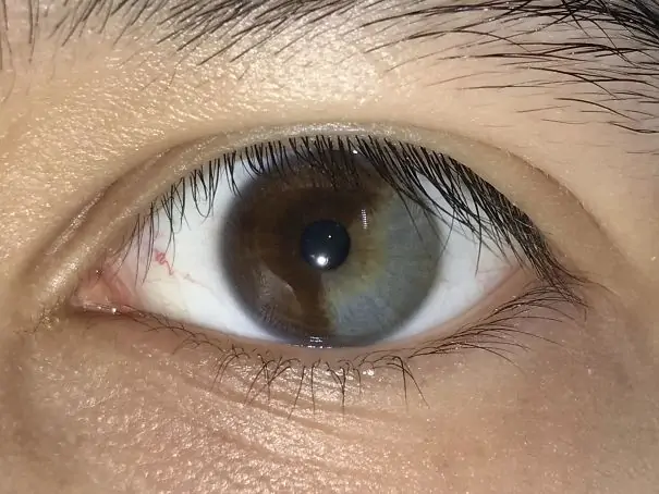 Heterochromia example 2