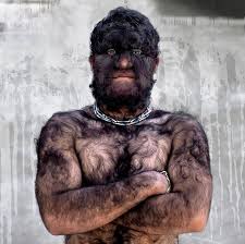 Hypertrichosis example 1
