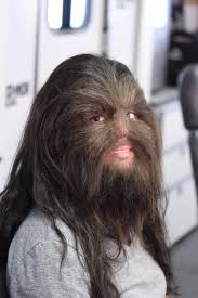 Hypertrichosis example 2